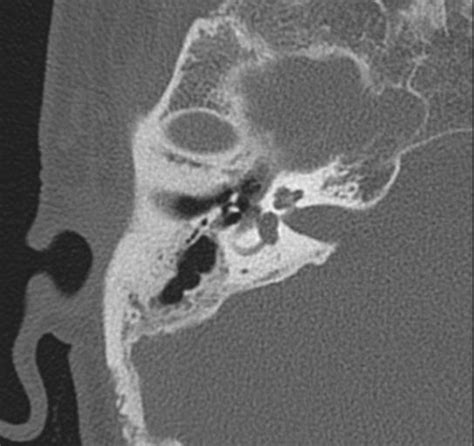 Acoustic Schwannoma Cystic Image Radiopaedia Org