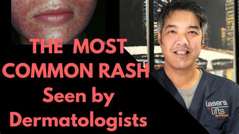 How To Treat Perioral Dermatitis Dermatologist Explains YouTube