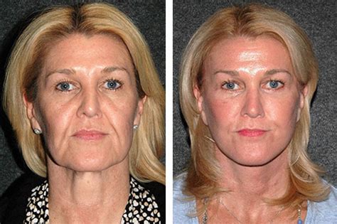 Best Facelift Surgeon | Best Facelift Surgeon in America