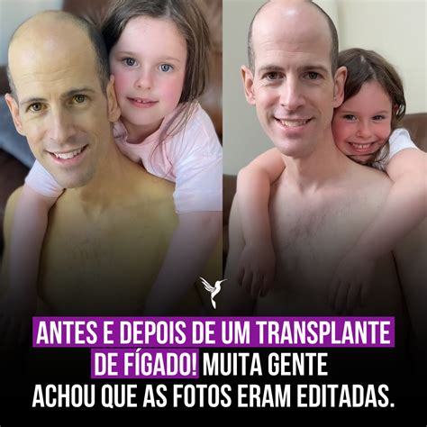 Bebe Com Icterícia Antes E Depois - Razões Para Acreditar | Antes e depois de um homem que fez um ...