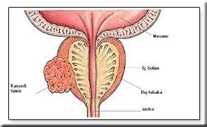 Prostat Kanseri Profes R Doktor Zcan Atahan Roloji Uzman Eswt
