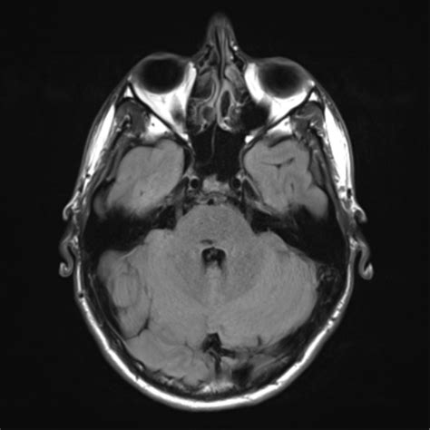 Spinal Arteriovenous Malformation Image