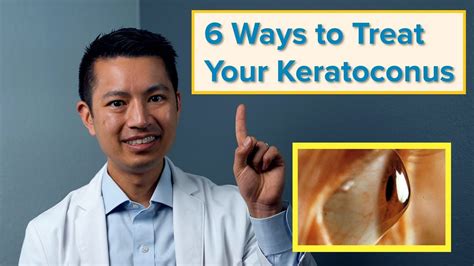 The 6 Best Ways To Treat Your Keratoconus Youtube