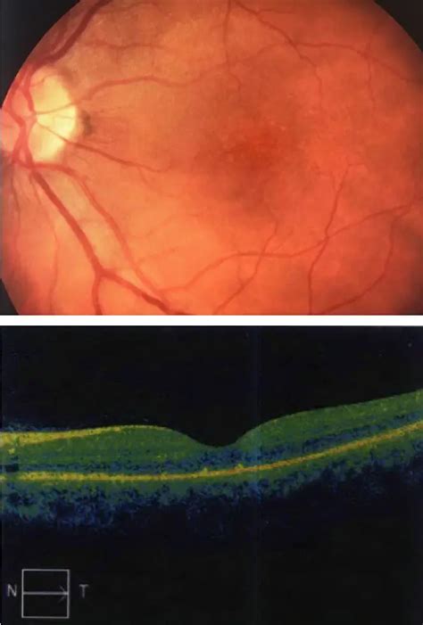 Ocular syphilis - American Academy of Ophthalmology