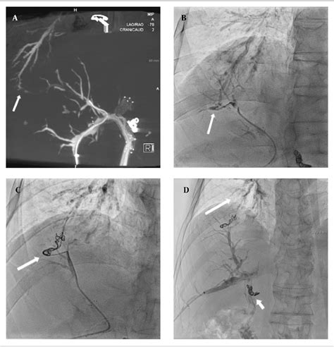 Figure 1 From Successful Percutaneous Transhepatic Embolization Of The