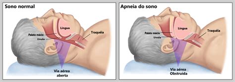 Apneia do sono Airmed Aluguel de Oxigênio Domiciliar e CPAP