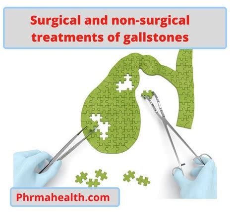 Gallstones treatment without surgery – Phrmahealth