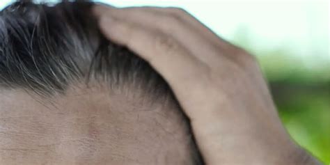 How To Stop Alopecia Areata From Spreading Causes Of Alopecia Areata