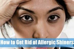 How to Get Rid of Allergic Shiners? Answer Here