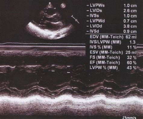 Left Ventricular Measurements In M Mode Echo All About Cardiovascular System And Disorders