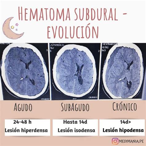 Hematoma Subdural Causas Sintomas Y Tratamiento Claves Diagnosticas