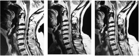 Sagittal Mri Demonstrating Pre Operative Multilevel Cervical Spinal