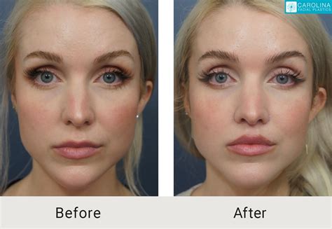 Is Permanent Lip Filler Really A Thing Carolina Facial Plastics