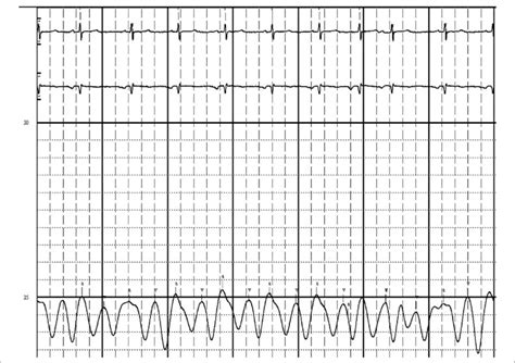 Right Atrial Waveforms Notice The Prominent Y Decent Which Is Larger