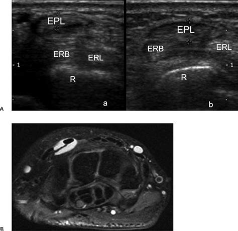 Extensor Pollicis Longus Mri