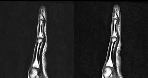 Ultimate Radiology Glomangioma Glomus Tumor