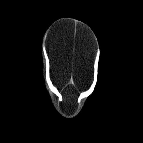 Hydranencephaly Eurorad