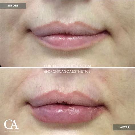 Lip Injections Before After Chicago Aesthetics Medspa