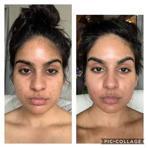 Update Started Tret End Of April 2020 And So Far These Are My Results R Tretinoin