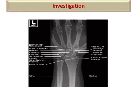 Wrist joint | PPT