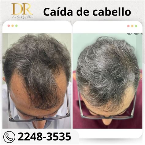 Trata Tu Alopecia Nosotros Somos Su Soluci N Dr Eric Rojas