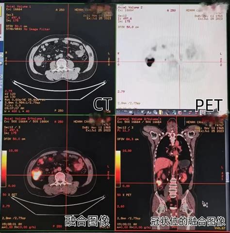 做完ct，为啥还要做pet Ct？河南省肿瘤医院专家这样说凤凰网河南凤凰网