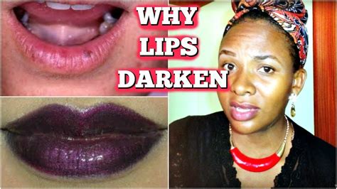 Darkening Of Lips Causes And Remedies Why Lips Darken Youtube