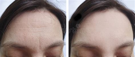 Female Forehead Wrinkles before Treatment Biorevitalization Stock Image - Image of correction ...