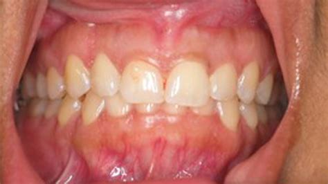 Lanap Laser Gum Disease Treatment Northbrook Glenview Il