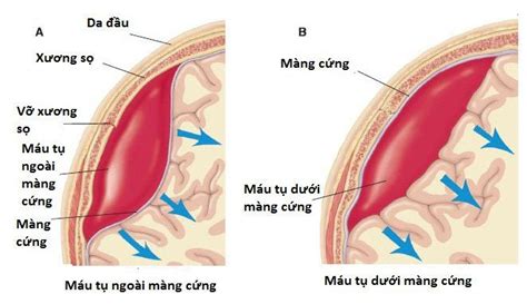 Huyết khối tĩnh mạch màng cứng là gì? | Vinmec