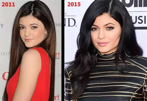 Kylie Jenner And Plastic Surgery Cosmetic Town