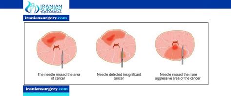 prostate biopsy anesthesia - Iranian Surgery