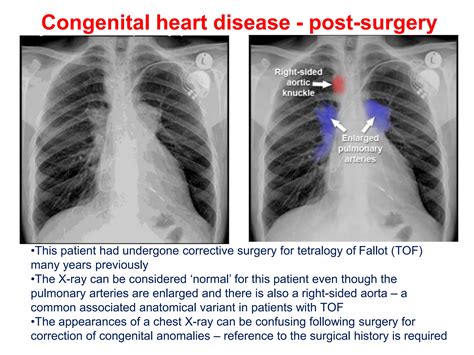 Chest X Ray Cardiac Diseasepptx Free Download