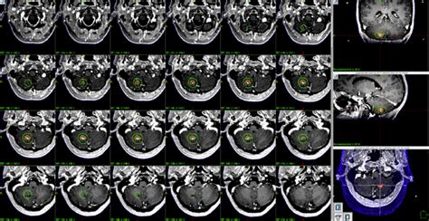 Gamma knife radiosurgery treatment plan. | Download Scientific Diagram