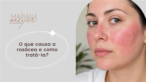 O Que Usar Para Rosacea No Rosto - Rosácea no rosto e na pele: causas e tratamentos - Dra. Mariana Meyer
