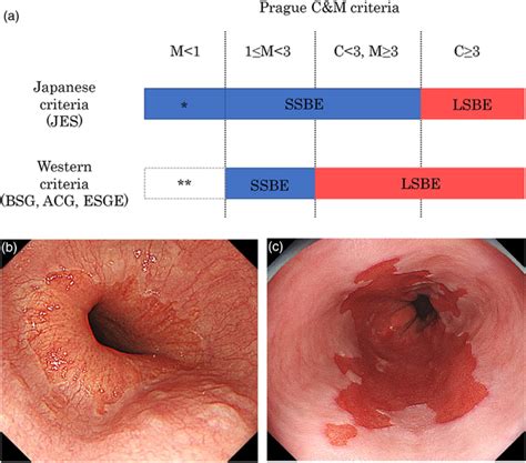 Diagnosis Of Barrett S Esophagus Based On Length A In Japan