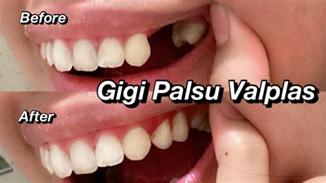 Pengalaman Pakai Gigi Palsu Lepasan Jenis Valplast Berapa Harga Dan