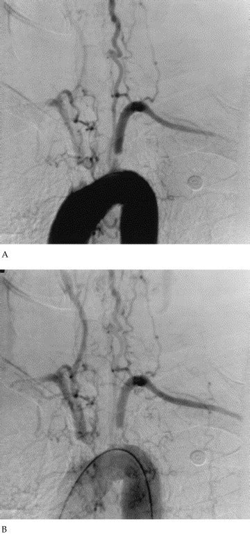 Common brachiocephalic trunk: strategies for revascularization - The ...