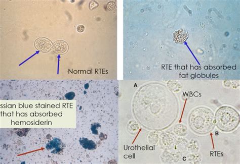 Transitional Renal Epithelial Cells In Urine