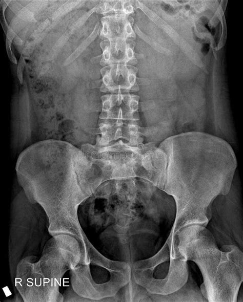 radiographic image   kub kidneys ureters bladder stock photo