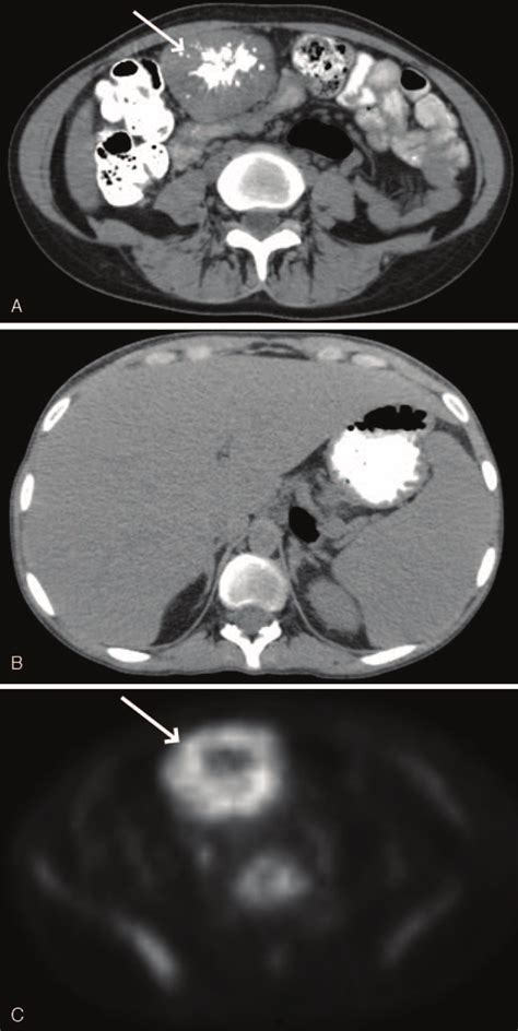 Ct Scan Of The Abdomen Showing Mesenteric Mass A Top Non Fdg Avid Download Scientific