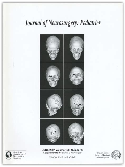 Spinal Deformities Following Selective Dorsal Rhizotomy In Journal Of