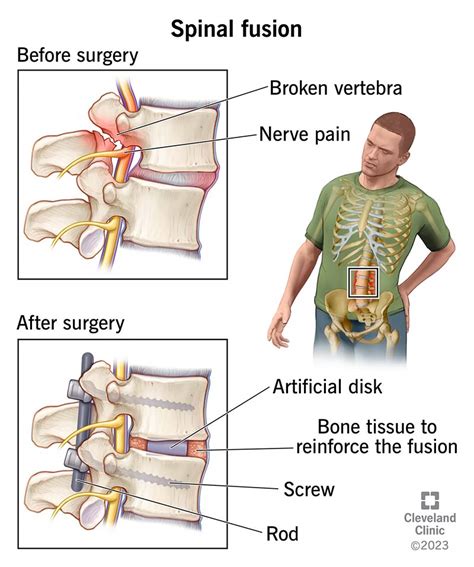 Spondylolisthesis Surgery Before And After