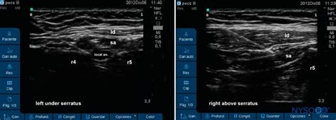 Serratus Anterior Plane Block - County EM