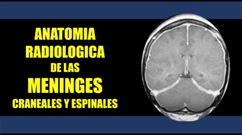 Anatom A Radiol Gica De Las Meninges Craneales Y Espinales Youtube