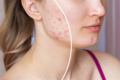 Is Laser Treatment The Right Approach Towards Acne Scar Removal