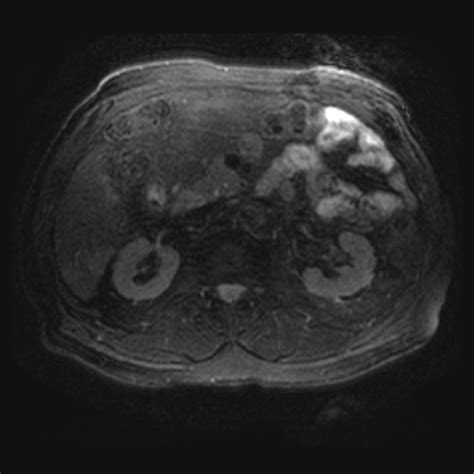 Fileliver Metastases Prostate Centrally Necrotic Radiopaedia 17769 17528 Axial 22 Nc