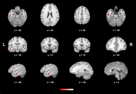 Structural Brain Changes Associated With Antipsychotic Treatment In