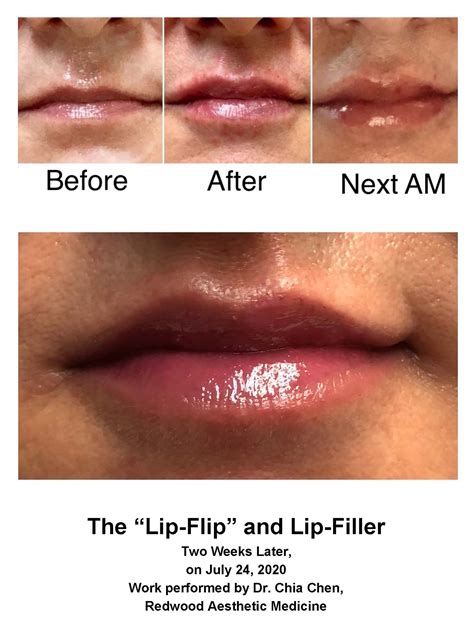 Lip Flip Botox Before And After Photos - Infoupdate.org