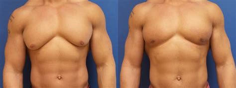 Male Breast Reduction Before After Photo Gallery Webster Tx